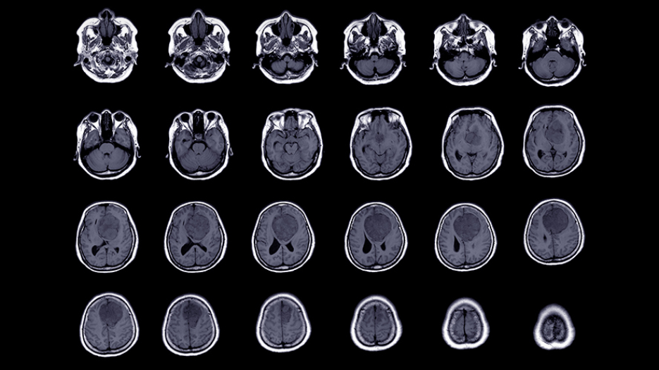 MRI images of meningioma tumour